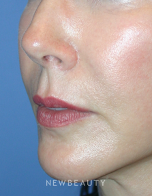 Dr. Kelly Bomer, Facelift, Chin Augmentation - After