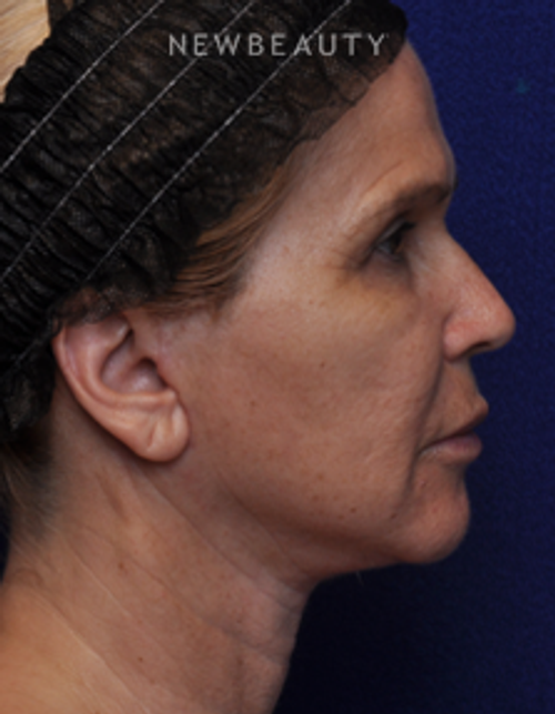 Dr. Alan J. Durkin - Facelift - After