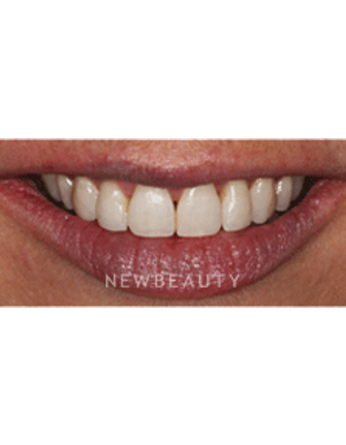 Dr. Neal Patel Braces - After