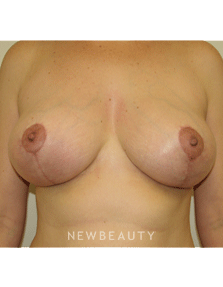 Dr Sean Simon Breast Augmentation - After