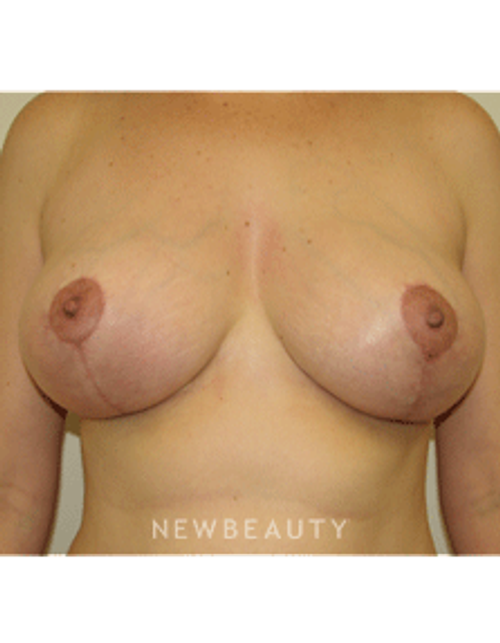 Dr Sean Simon Breast Augmentation - After