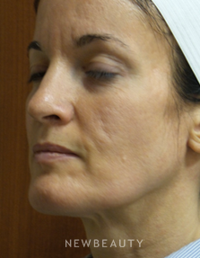 Dr. Jody Levine - Injectables and Fillers - Before