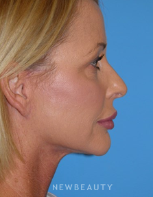 Dr. George Sanders - Necklift - After