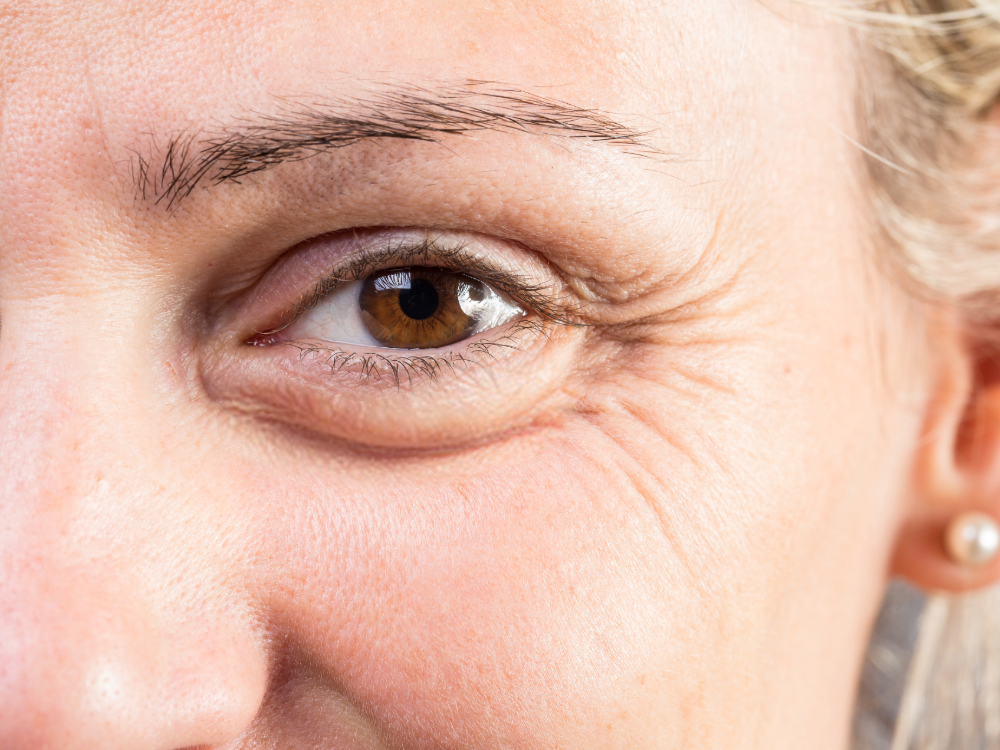 how to fix under-eye-bags