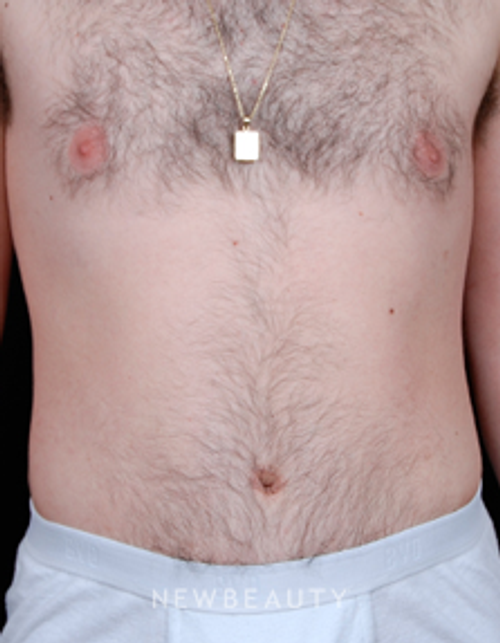 Dr. Steven Bloch Liposuction, Tummy Tuck - After
