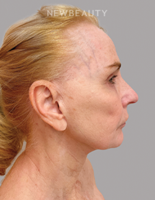Dr. Joel Schlessinger – Botox, Injectables And Fillers and Lasers – 53105442 - After