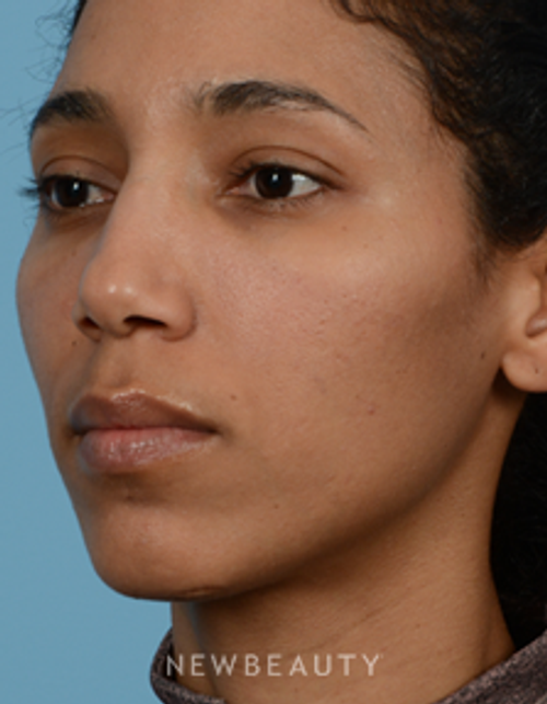 Dr. Jeffrey B. Wise - Nasal Tip Refinement - Before