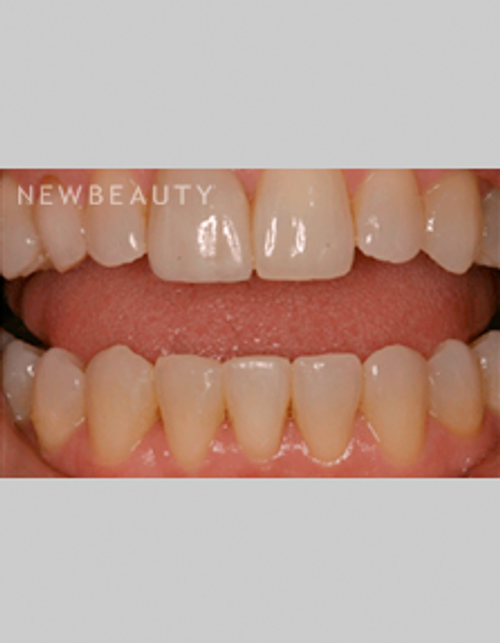 Dr. Bob Perkins Veneers, Invisalign - After