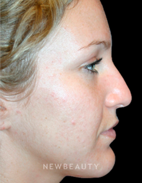 Dr. Kelly Bomer Rhinoplasty - Before