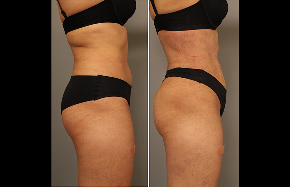 before and after RibXcar