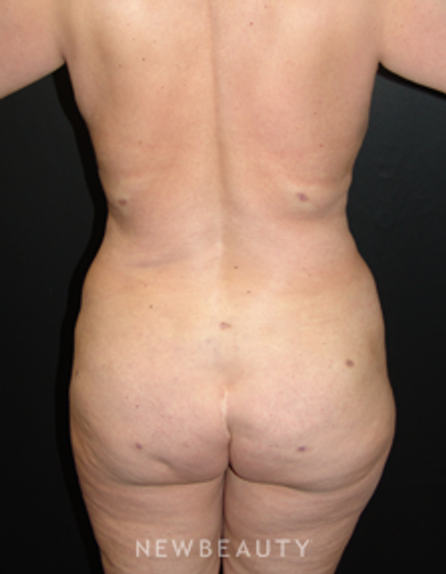 Dr. Mokhtar Asaadi Liposuction - After