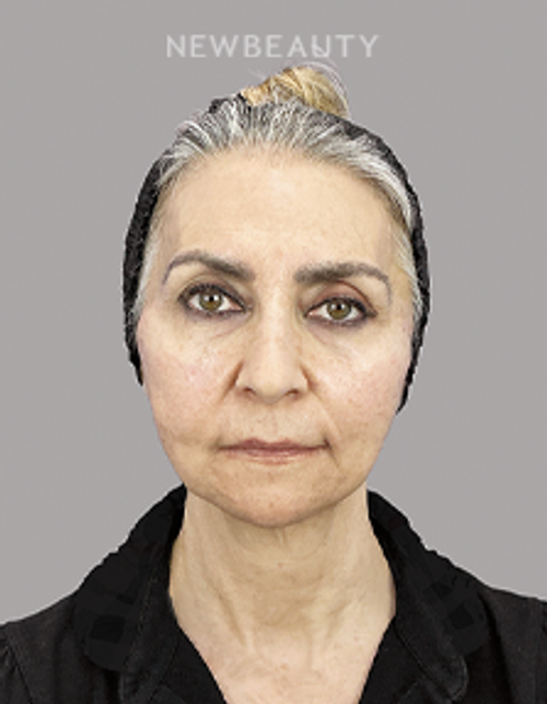 Dr. Sheila Barbarino-Thread Lift-54798899 - After