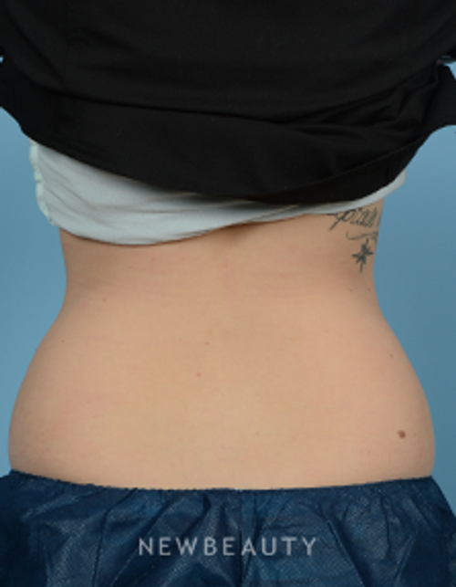 Dr. Jeffrey Wise - CoolSculpting - Before