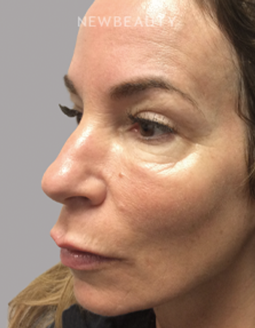 Dr. Linda Honet - Injectables & Fillers - 15045893 - After