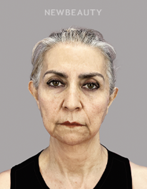 Dr. Sheila Barbarino-Thread Lift-54798899 - Before