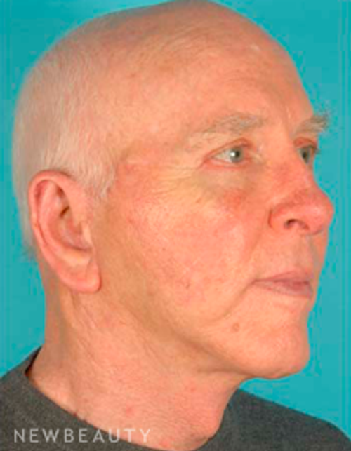 Dr. David Kim Facelift - After