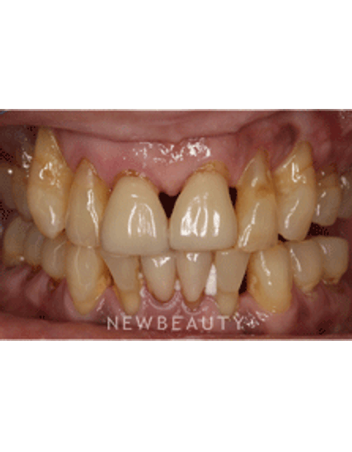 Dr. Neal Patel Smile Makeover - Before