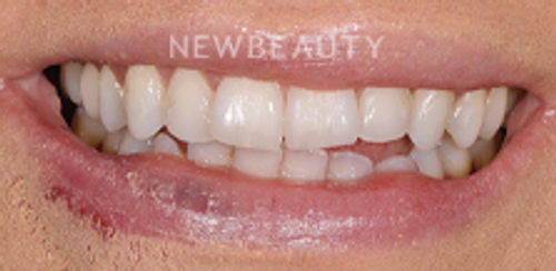 Dr. Salvator La Mastra – Smile Makeover - 46106939 - Before