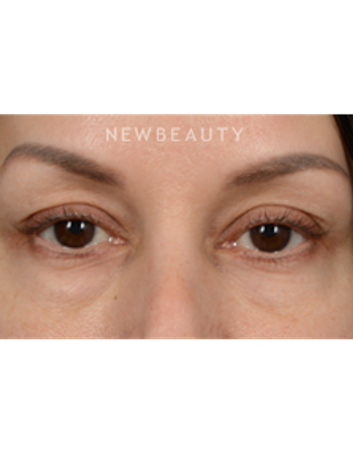 Dr. Jeffrey Wise - Lower Blepharoplasty - Before