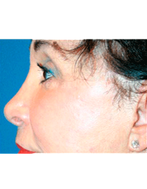 Dr. Kelly Bomer Liquid Facelift - After
