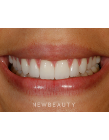 Dr. Patrick Broome - Gum Lift - After