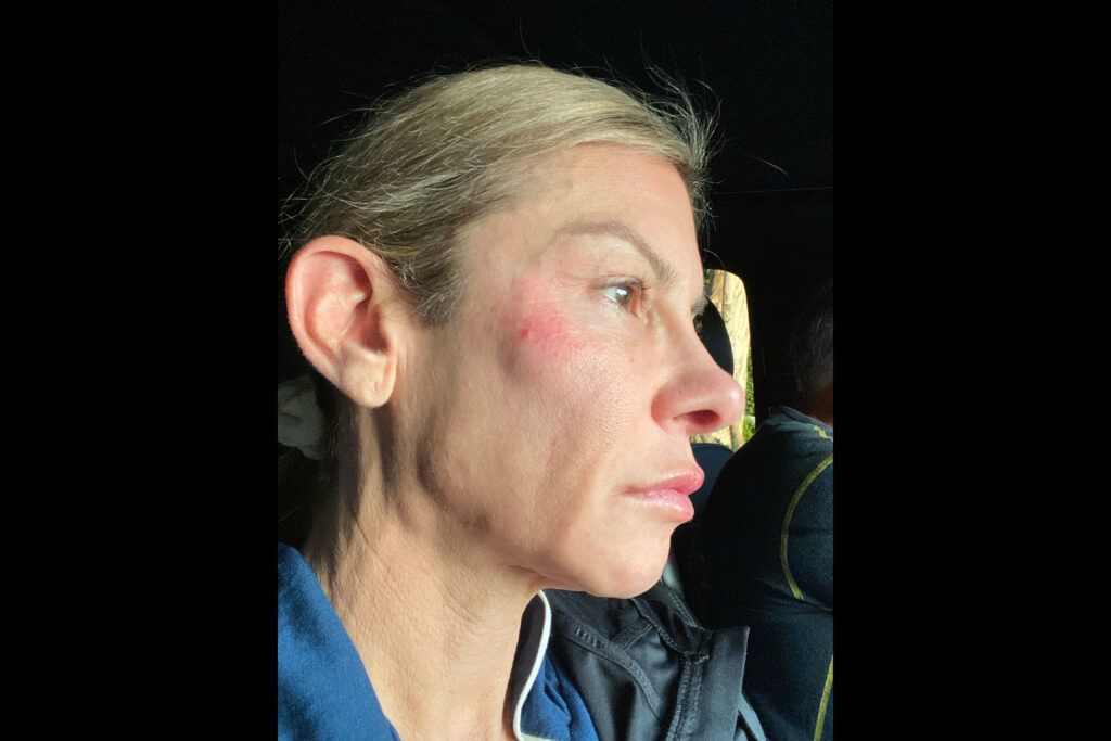 A view of Janine's tumor before her surgery.