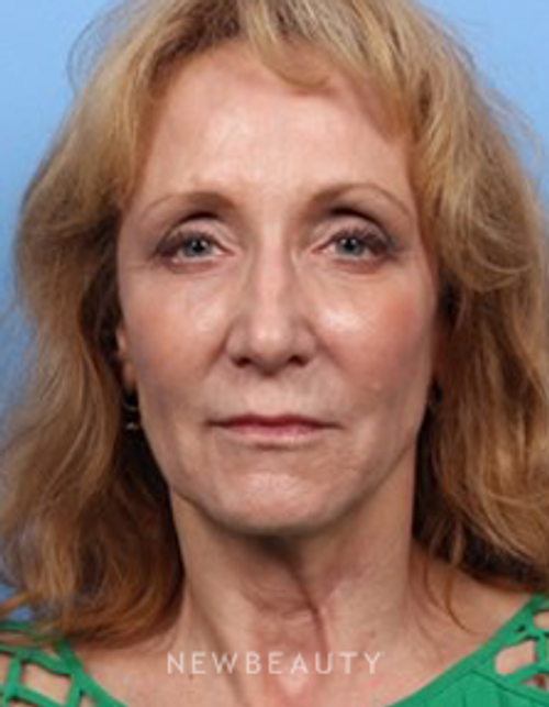Dr. Kelly Bomer - Liquid Facelift - After
