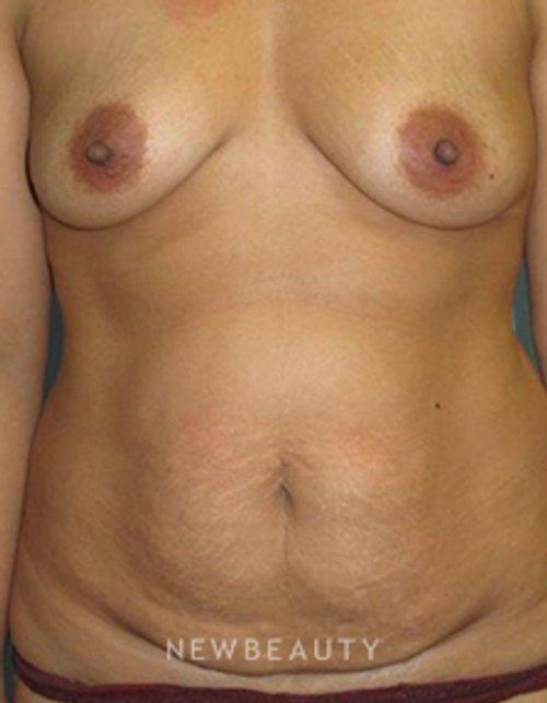 Dr. B. Aviva Preminger - Breast Augmentation - Before