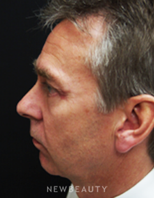 Dr. Mokhtar Asaadi Eyelid Lift, Facelift, Necklift - After