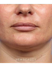 Dr. Kelly Bomer - Lip Fillers - After