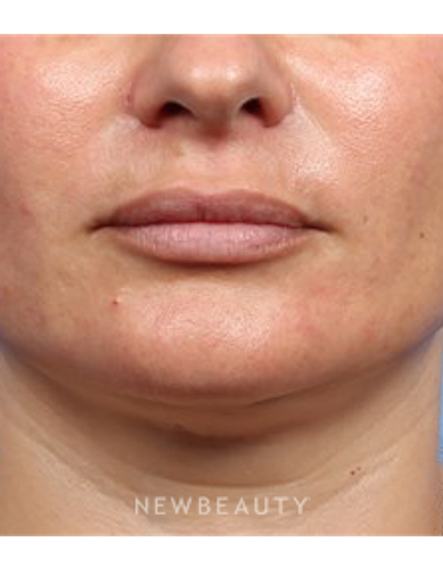 Dr. Kelly Bomer - Lip Fillers - After
