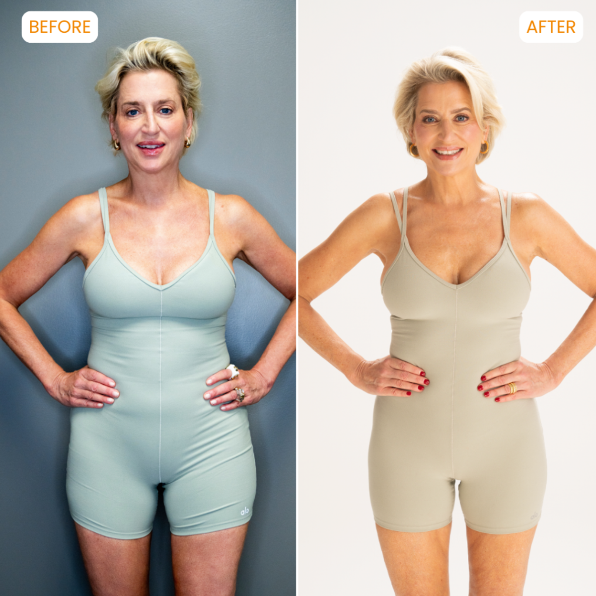 dorinda medley liposuction