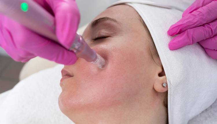 Woman getting microneedling treatment