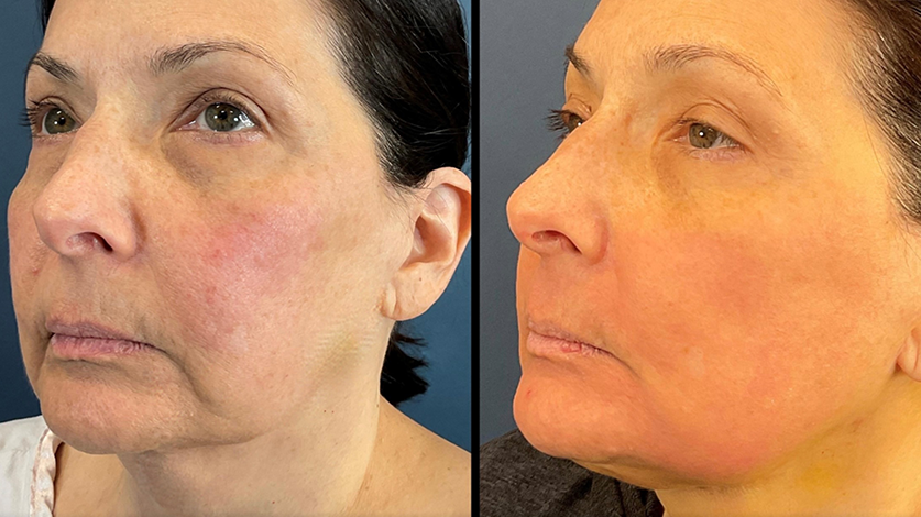 Before and after LaMiNa treatment, one week post op, Real Patient Stories, Tatiana Bido