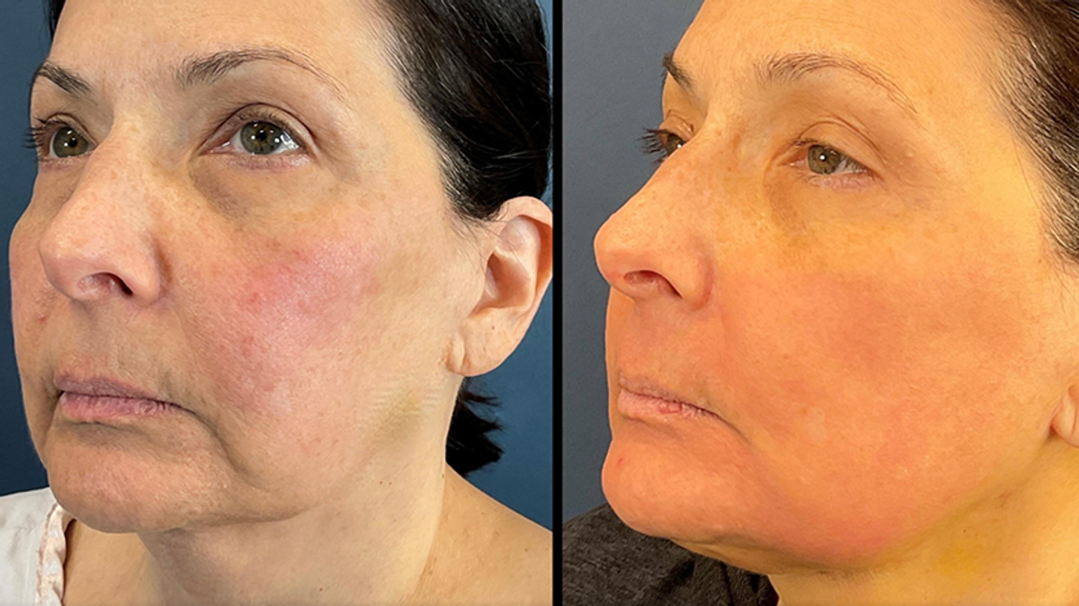 Before and after LaMiNa treatment, one week post op, Real Patient Stories, Tatiana Bido