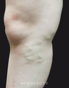 Dr. Jody Levine Vein Treatments - Before