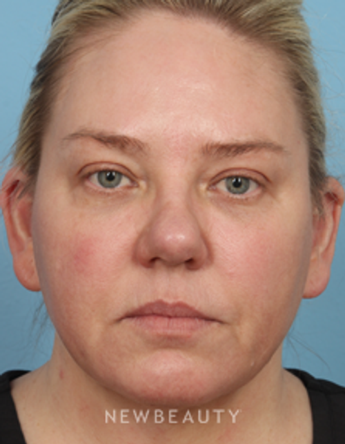 Dr. Kathleen Behr - Natural-Looking Facial Rejuvenation - After