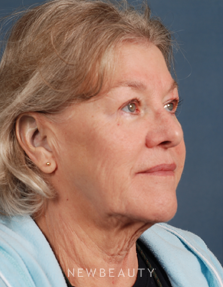 Dr. Bradley Calobrace Facelift - Before