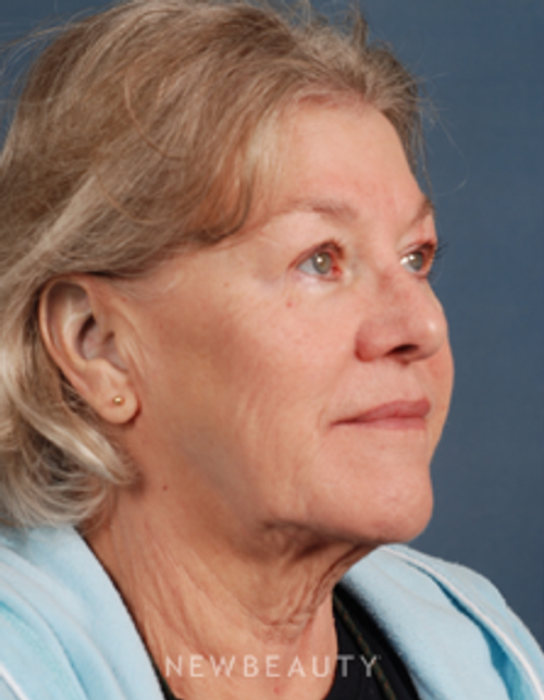 Dr. Bradley Calobrace Facelift - Before