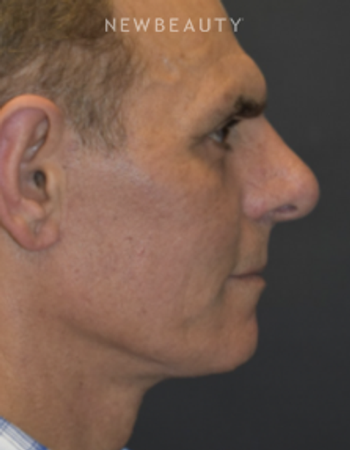 Drs. Lieberman & Parikh - Signature Facelift - After