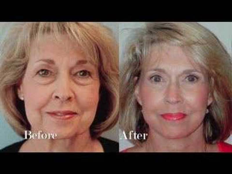 Dr. Mentz Face Lift
