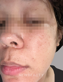 Dr. Anna Chacon - Angular Cheilitis - 34279225 - Before