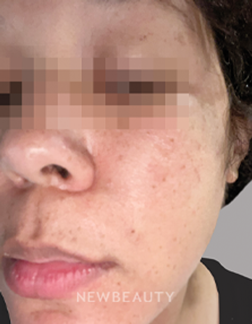 Dr. Anna Chacon - Angular Cheilitis - 34279225 - Before