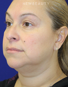 Dr. Dilip Madnani - Facelift & Necklift - Before