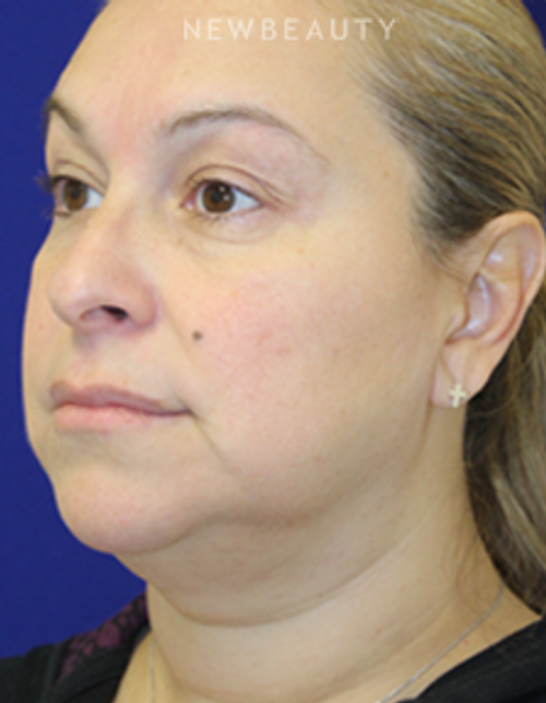 Dr. Dilip Madnani - Facelift & Necklift - Before