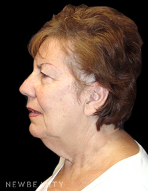 Dr. Mokhtar Asaadi Facelift - Before
