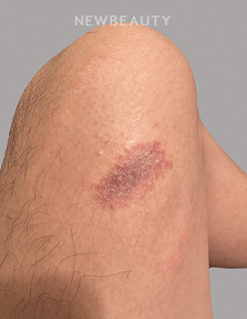 Dr. Anna Chacon – Allergic Dermatitis - 34277948 - After