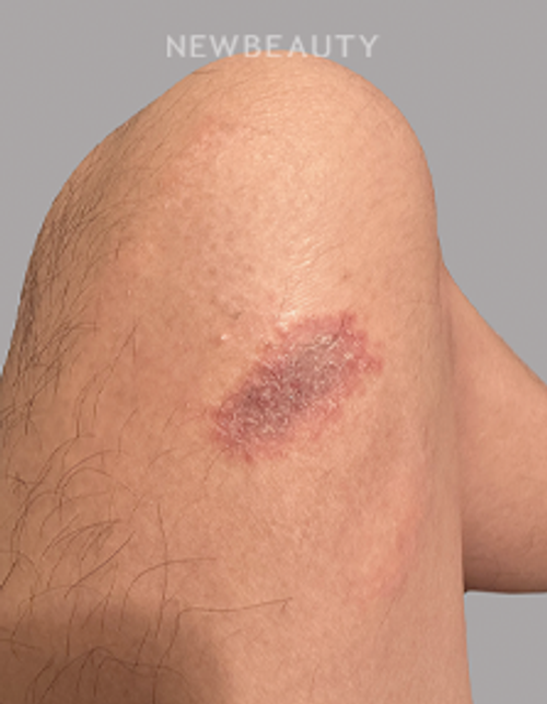 Dr. Anna Chacon – Allergic Dermatitis - 34277948 - After