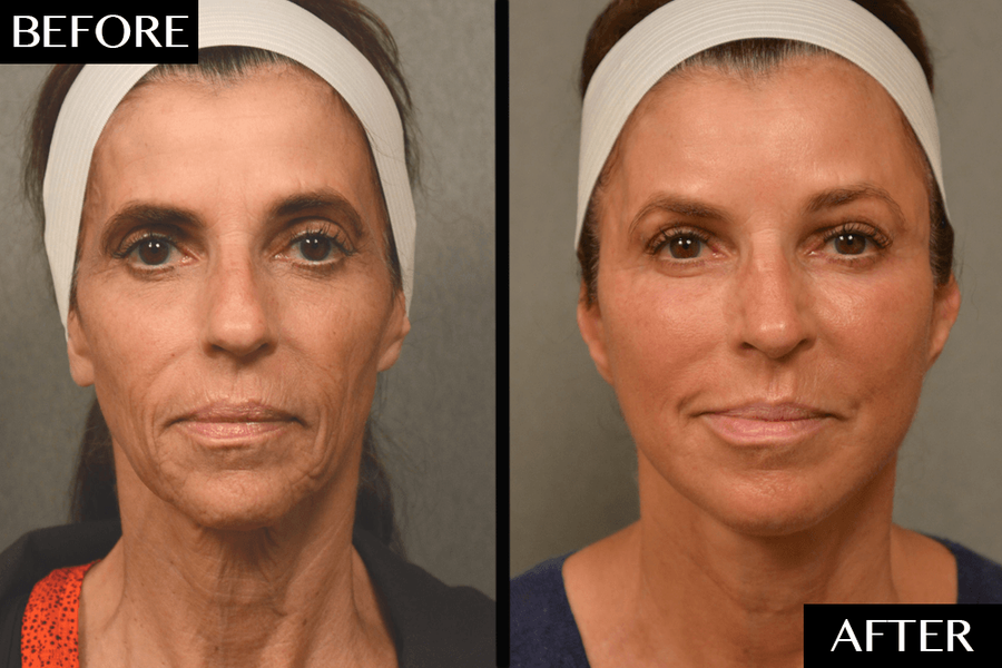 facelift1
