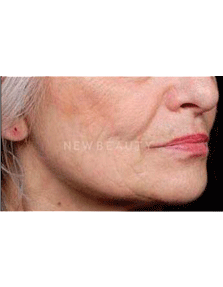Dr. Ruth Hillelson Lasers, Thermage - After